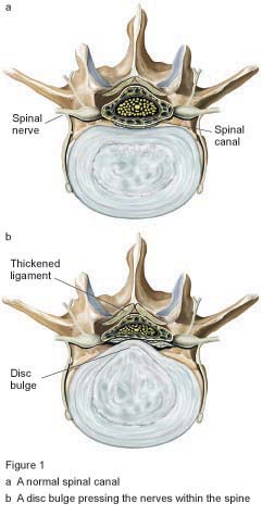 Lumbar Laminectomy New Victoria Hospital